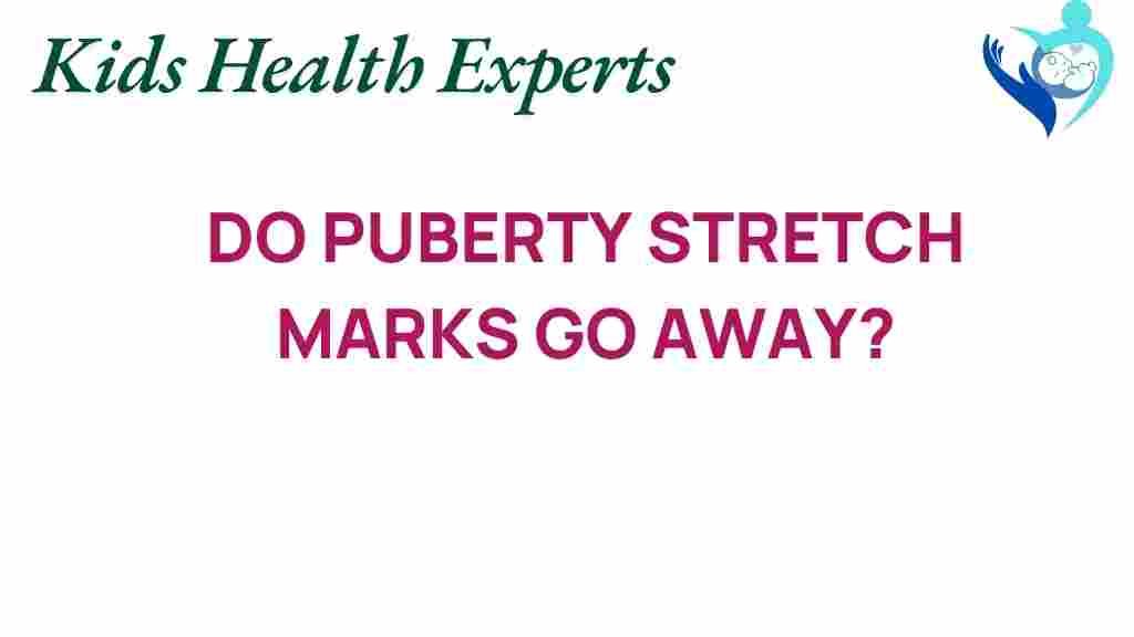 puberty-stretch-marks-fade